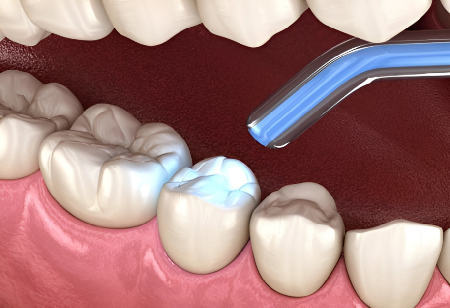Mercury-Free Dentistry
